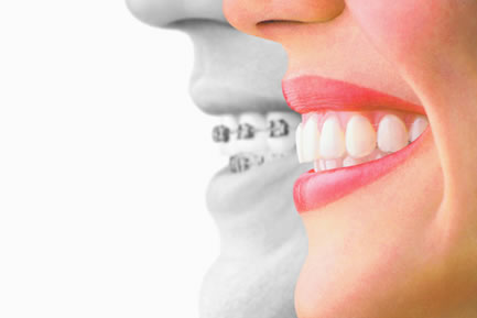 画像：ワイヤー矯正（表側矯正）＋マウスピース型矯正装置（クリアアライナー）