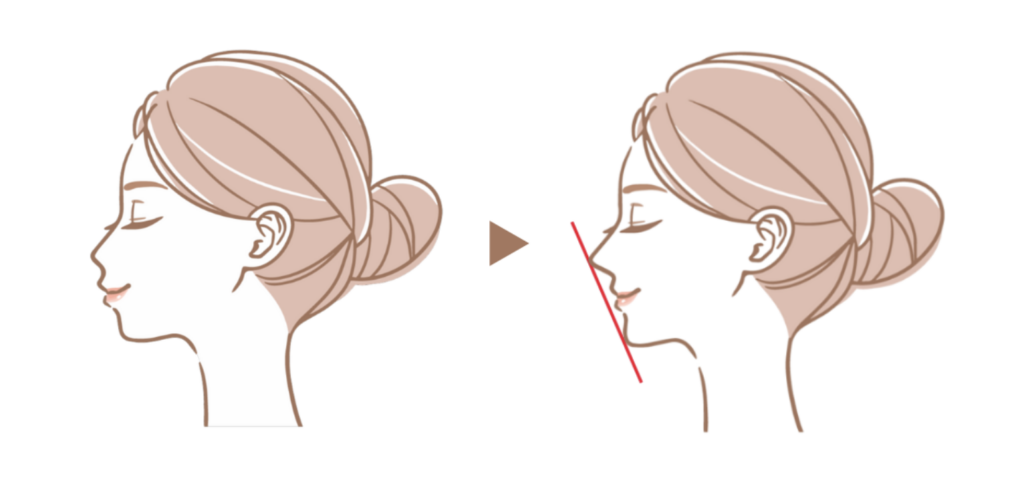 なぜ4本抜歯がス タンダードなのか?