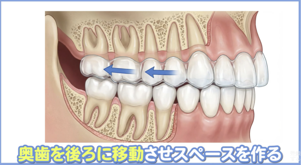 遠心移動:奥歯を親知らずの方向に動かしてスペースを作る