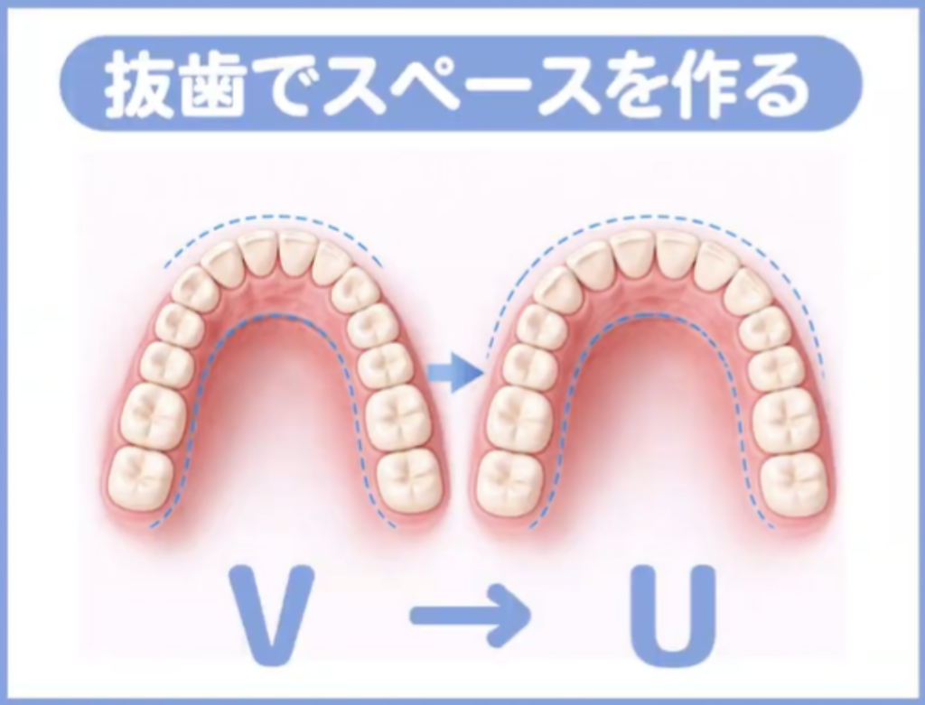 歯並びが悪くなる根本原因:スペース不足