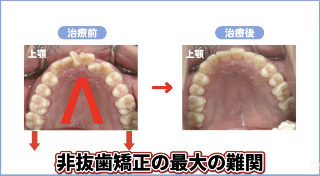 非抜歯矯正を可能にするメカニズム