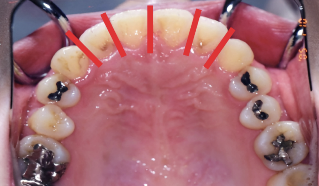 隣接面削合(IPR)