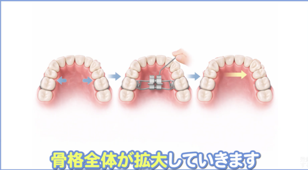 抜かない矯正の適応条件:年齢による決定的な違い