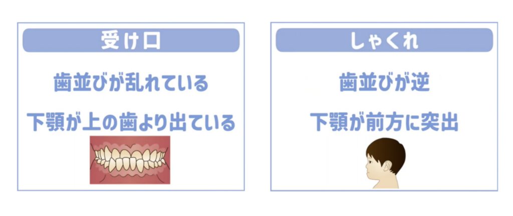 受け口とは?