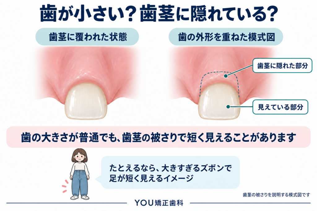 歯茎に覆われて歯が短く見える状態と、歯茎に隠れた部分を示す模式図