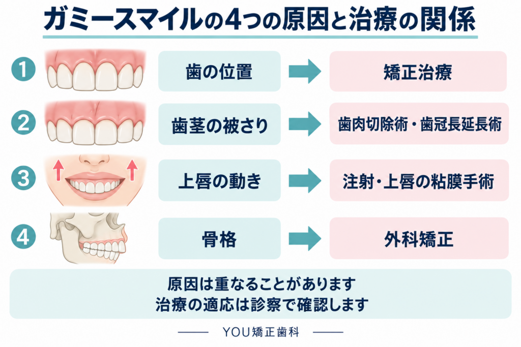ガミースマイルの4つの原因である歯の位置・歯茎の被さり・上唇の動き・骨格と、対応する治療法の関係